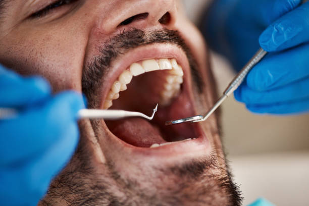 Best Emergency Wisdom Teeth Removal in Sa Loma, CA