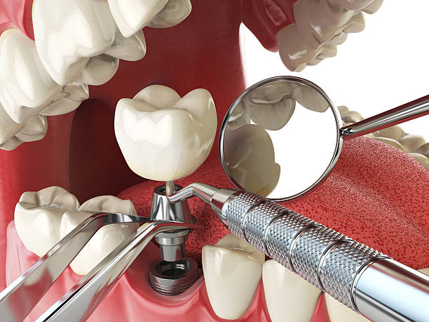 Best Emergency Root Canal Treatment in Sa Loma, CA